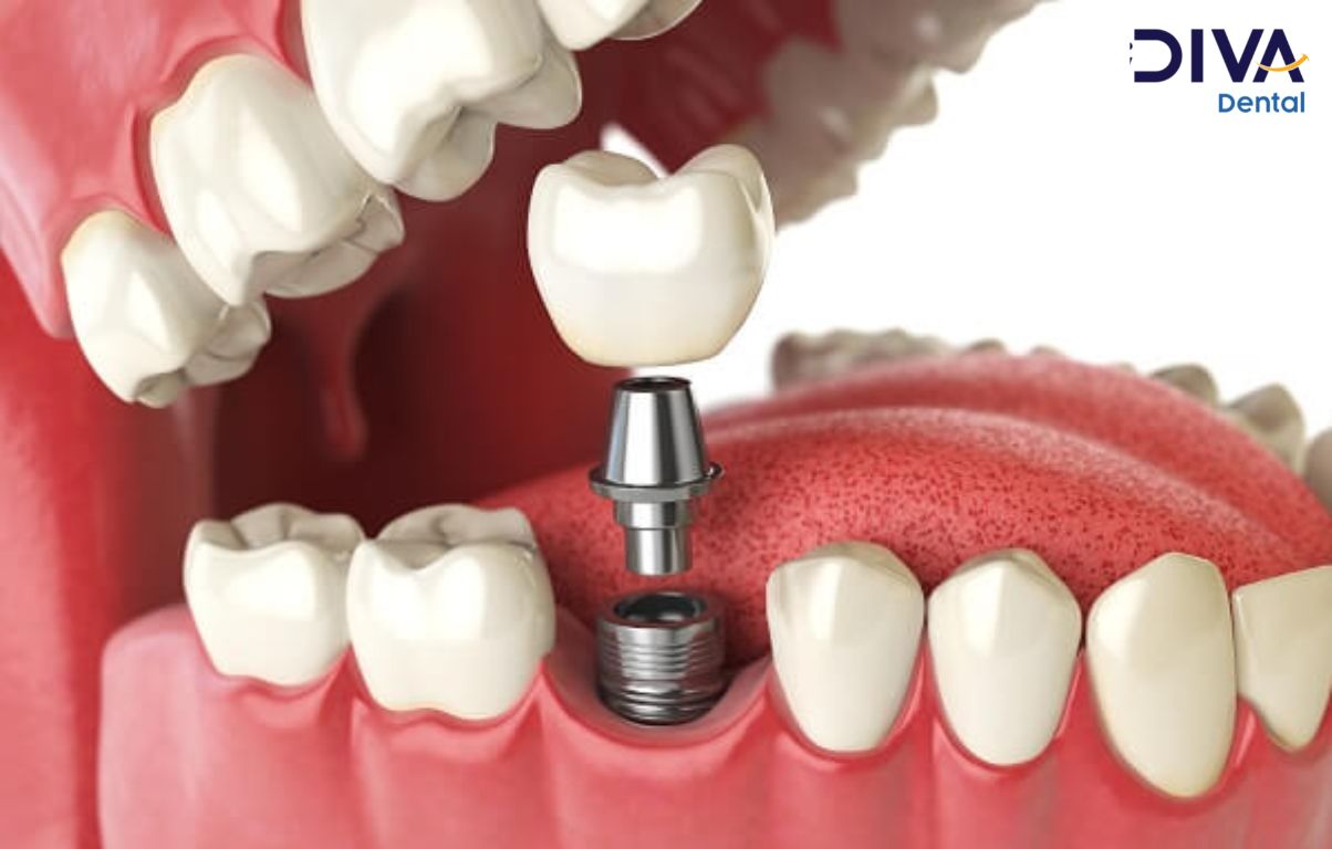 Trồng răng implant là phương pháp phục hình răng đã mất ưu việt nhất trong ngành nha khoa