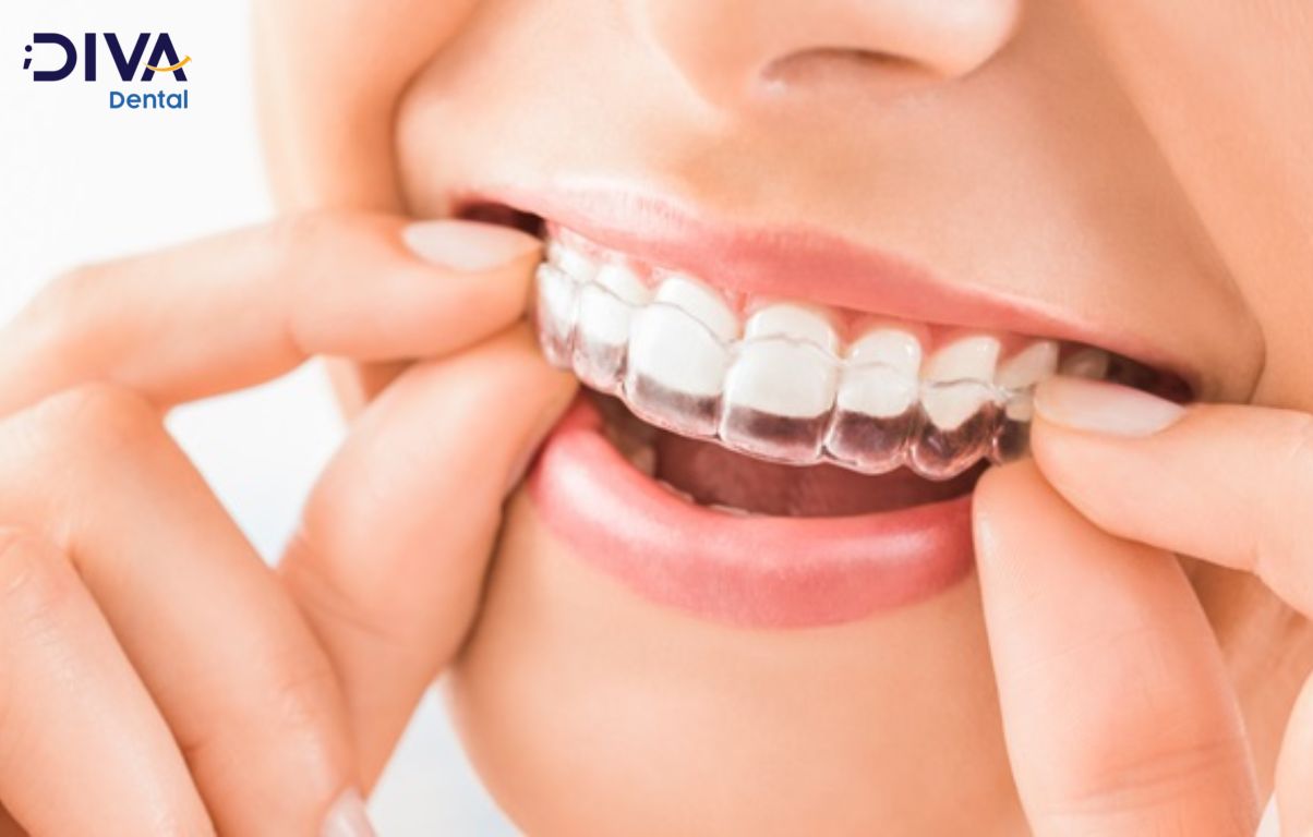 Niềng răng trong suốt là kỹ thuật niềng răng hiện đại nhất hiện nay