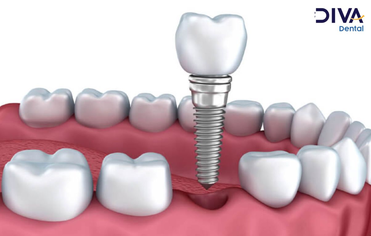 Trồng răng implant - trường hợp mất răng riêng lẻ