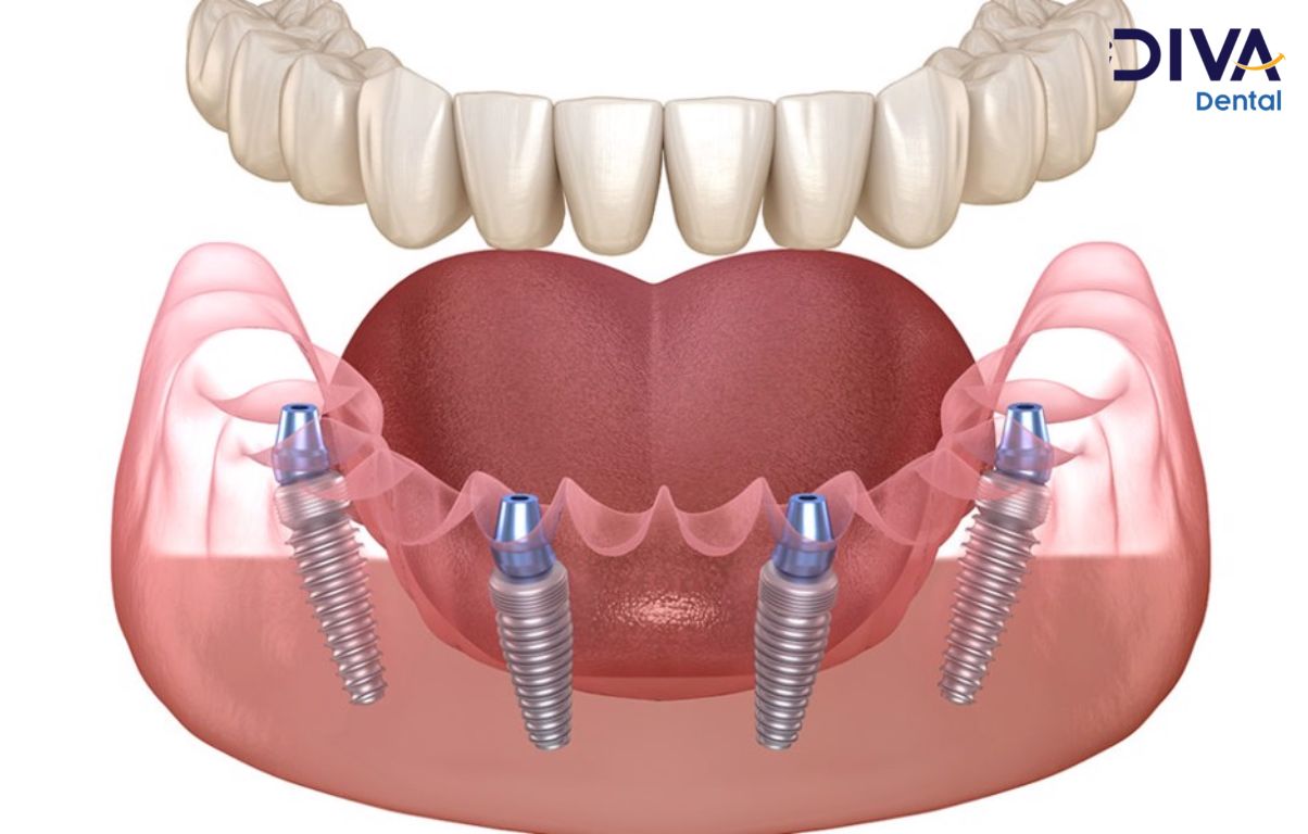 Trồng răng implant - trường hợp mất răng toàn hàm