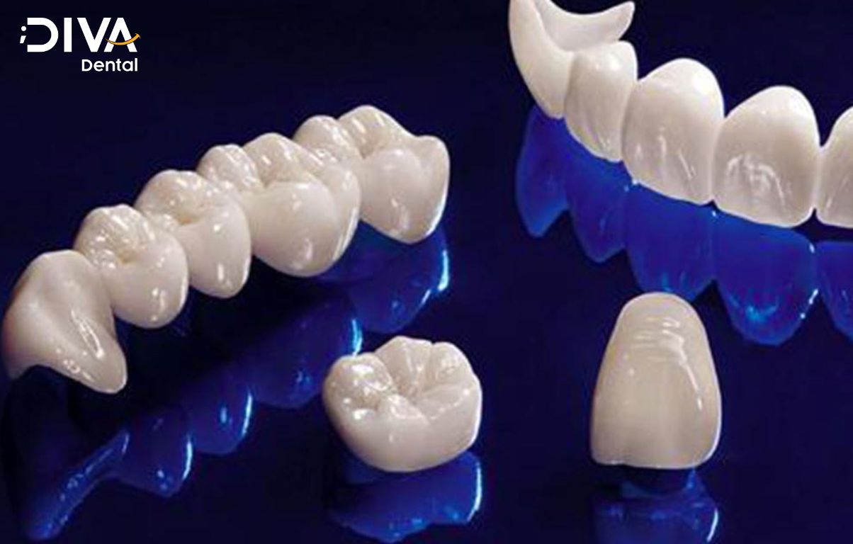 Răng sứ toàn sứ có cấu tạo hoàn toàn từ sứ nguyên khối, tính thẩm mỹ cao