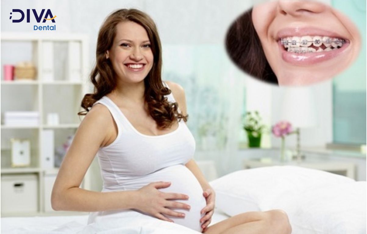 Việc chỉnh nha không gây tác động xấu đến mẹ bầu và em bé