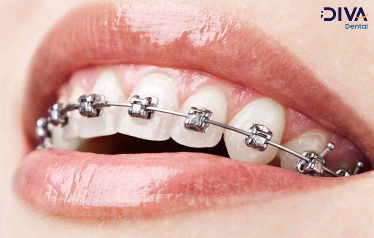 Niềng răng mắc cài kim loại khắc phục được hết các tình trạng răng từ đơn giản đến phức tạp 