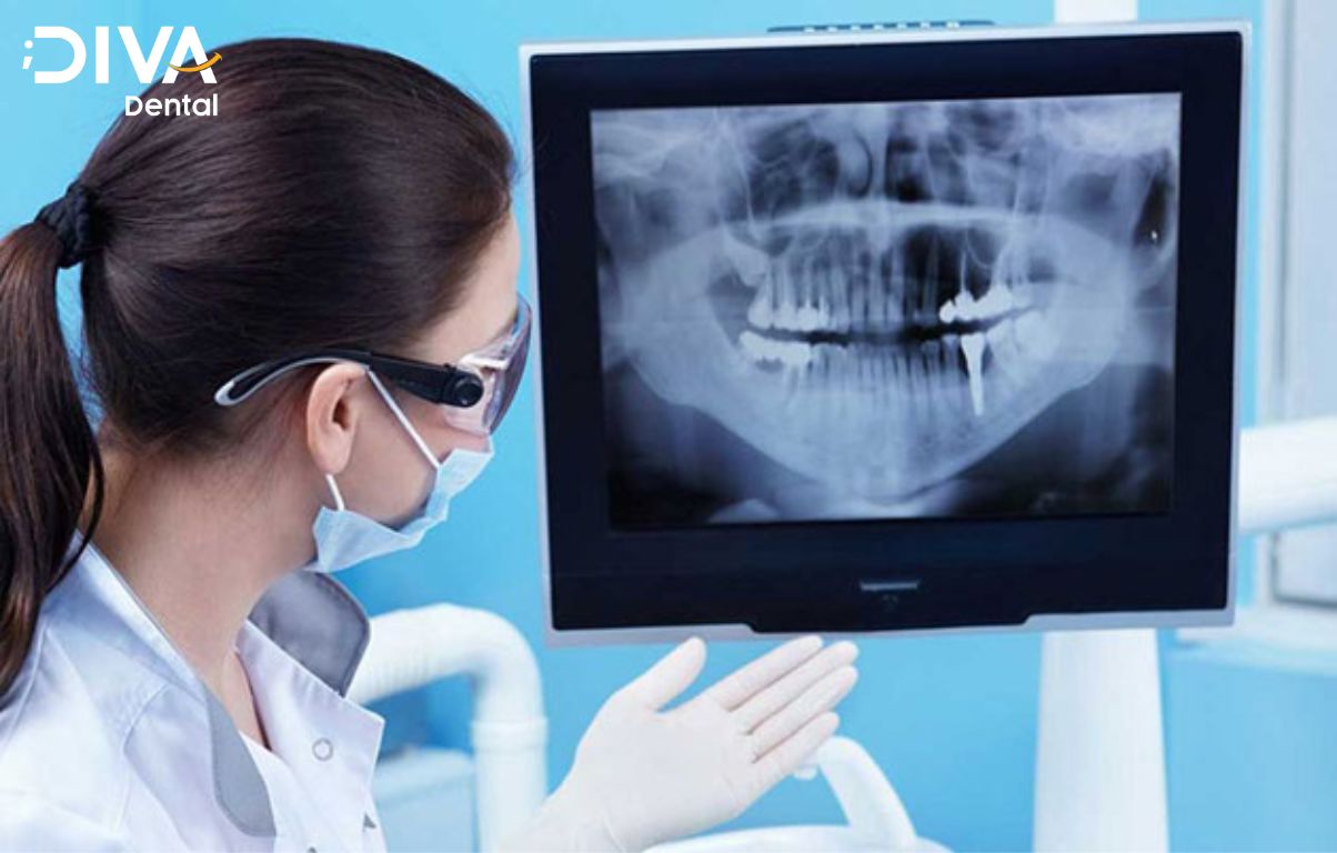 Quy trình trồng răng implant tại Nha khoa Diva nghiệm ngặt theo tiêu chuẩn bộ y tế