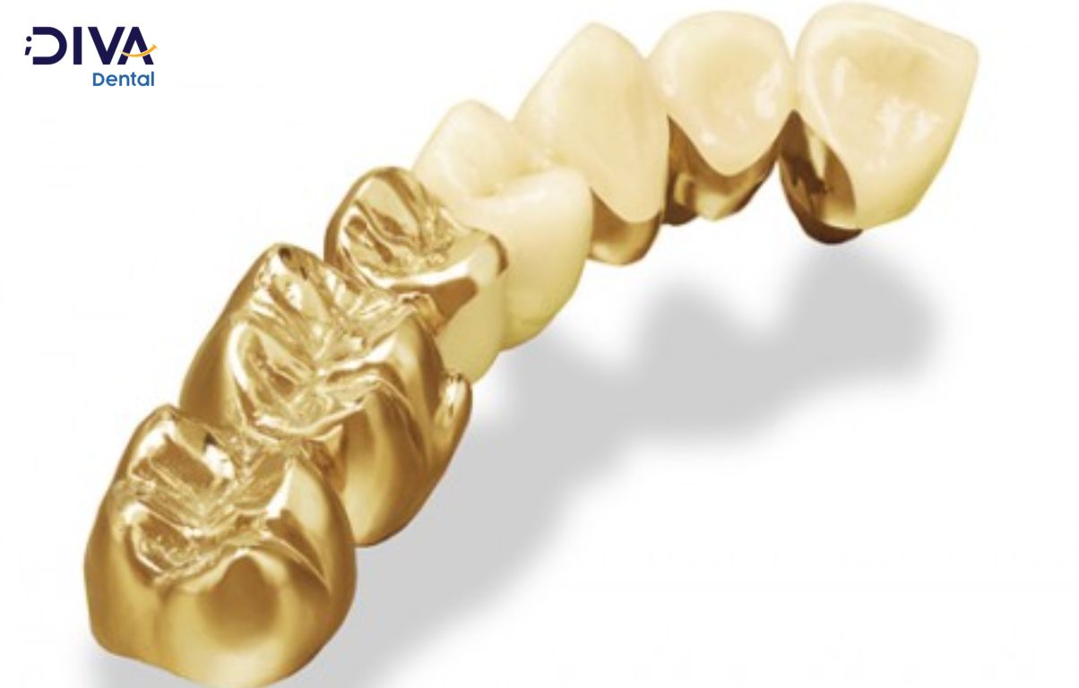 Răng sứ kim loại quý có phần sườn được làm từ một loại kim loại quý hoặc hỗn hợp kim loại quý