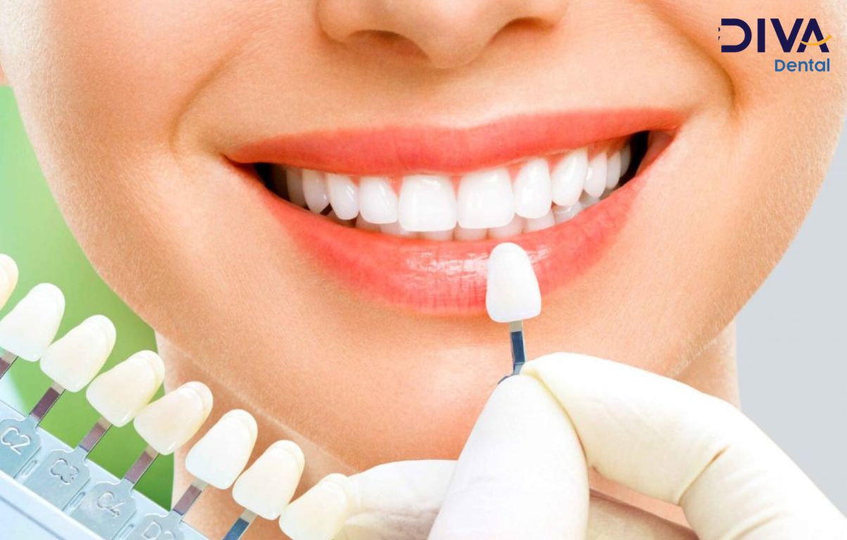 Quy trình bọc răng sứ tại Nha khoa Diva trải qua 5 bước