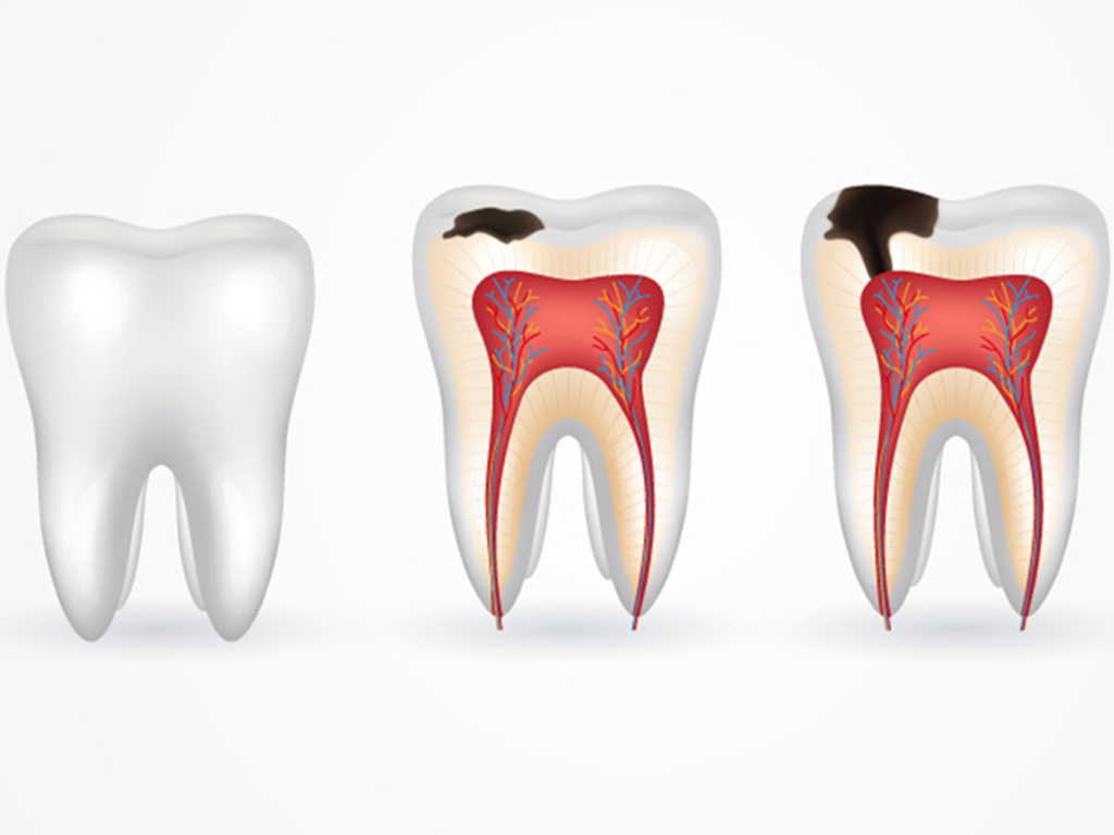 Sâu răng là 1 trong những bệnh lý răng miệng thường gặp ở mọi lứa tuổi
